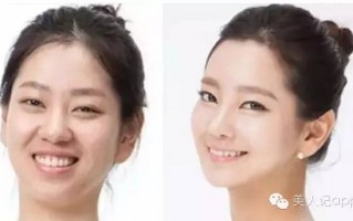 韩国整容前后对照的图片，韩国整容前后对照的图片大全